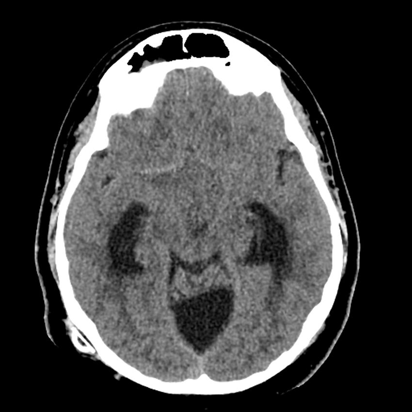 Chiasmatic-hypothalamic juvenile pilocytic astrocytoma (Radiopaedia 78533-91237 Axial non-contrast 25).jpg