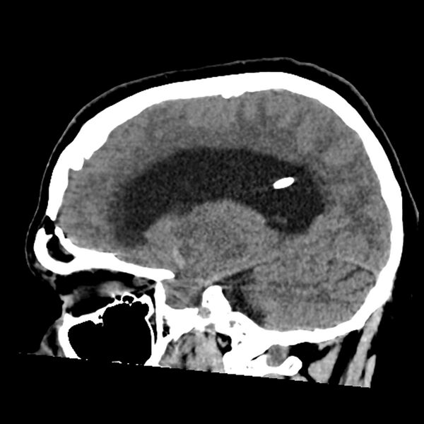 File:Chiasmatic-hypothalamic juvenile pilocytic astrocytoma (Radiopaedia 78533-91237 B 39).jpg