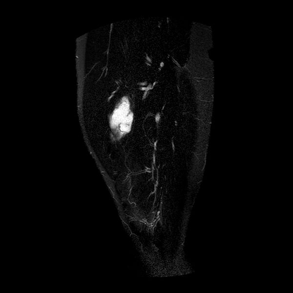 File:Chondrosarcoma arising from exostosis (Radiopaedia 59996-67686 Sagittal STIR 2).jpg