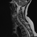 Chordoma (C4 vertebra) (Radiopaedia 47561-52189 Sagittal T2 9).png