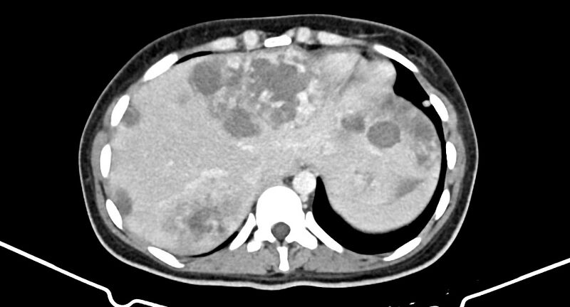File:Choriocarcinoma liver metastases (Radiopaedia 74768-85766 A 37).jpg