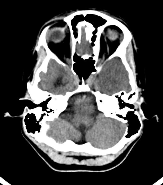 File:Choroid plexus carcinoma (Radiopaedia 91013-108552 Axial non-contrast 15).jpg