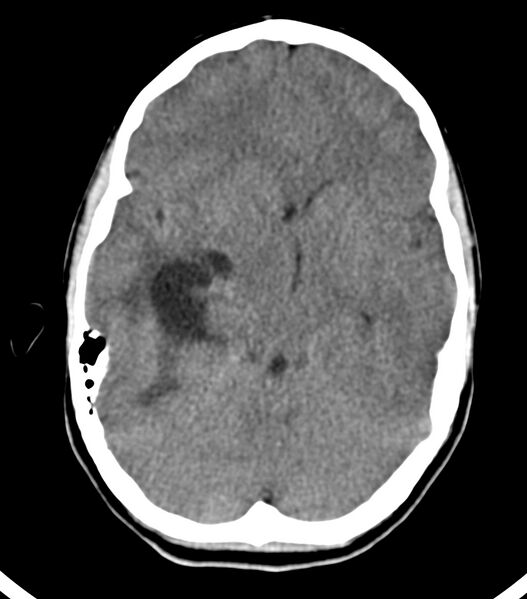 File:Choroid plexus carcinoma (Radiopaedia 91013-108552 Axial non-contrast 25).jpg