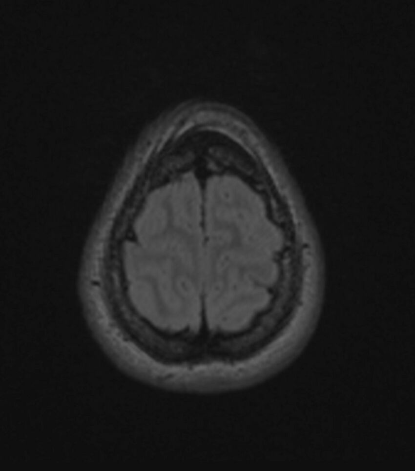 Choroid plexus carcinoma (Radiopaedia 91013-108553 Axial FLAIR C+ 191).jpg