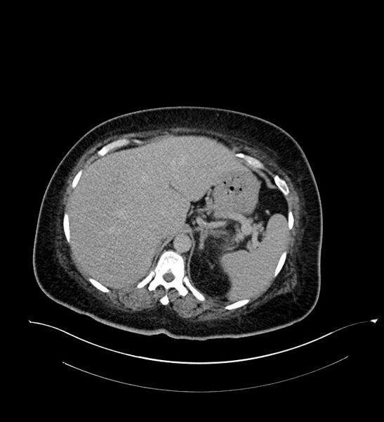 File:Chromophobe renal cell carcinoma (Radiopaedia 84239-99519 E 44).jpg