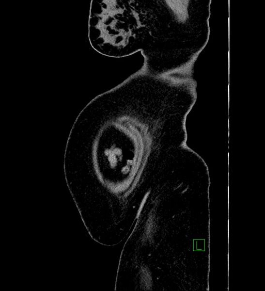 File:Chromophobe renal cell carcinoma (Radiopaedia 84239-99519 G 5).jpg