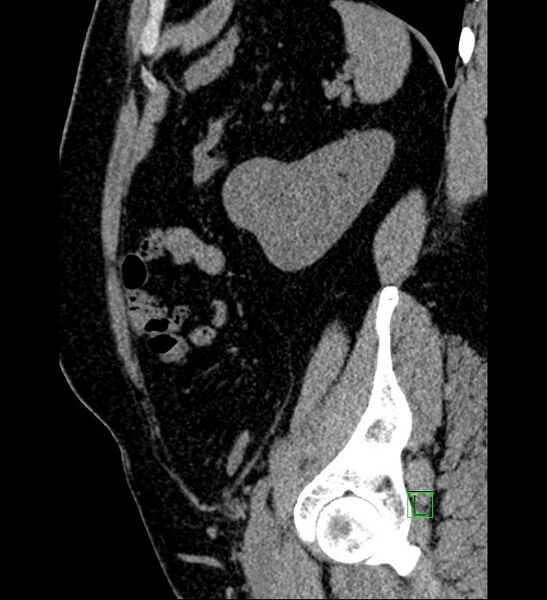 File:Chromophobe renal cell carcinoma (Radiopaedia 84286-99573 C 41).jpg