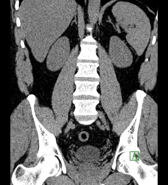 File:Chromophobe renal cell carcinoma (Radiopaedia 84286-99573 Coronal non-contrast 114).jpg