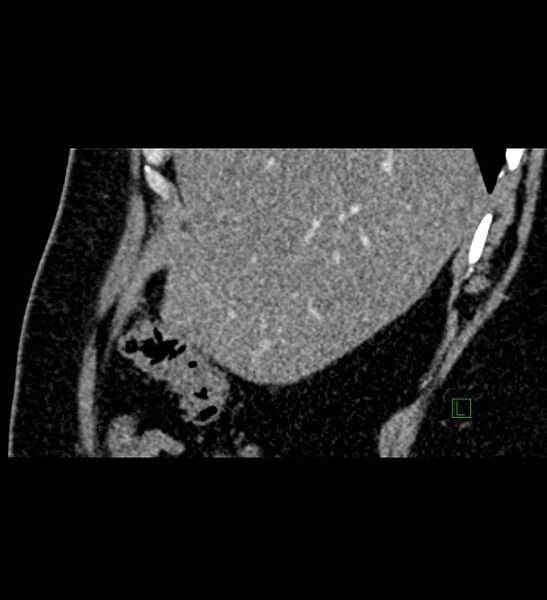 File:Chromophobe renal cell carcinoma (Radiopaedia 84286-99573 F 146).jpg