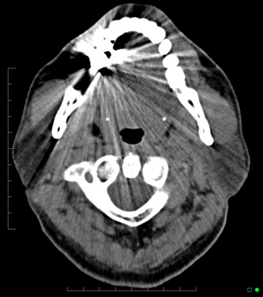 File:Chronic Submandibular sialolithiasis (Radiopaedia 16880-16606 Axial non-contrast 8).jpg