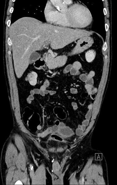 File:Chronic appendicitis complicated by appendicular abscess, pylephlebitis and liver abscess (Radiopaedia 54483-60700 C 27).jpg