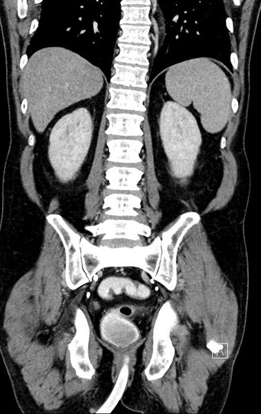 File:Chronic appendicitis complicated by appendicular abscess, pylephlebitis and liver abscess (Radiopaedia 54483-60700 C 60).jpg