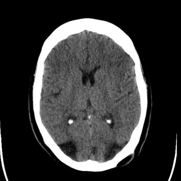 File:Chronic bilateral occipital lobe infarcts (Radiopaedia 31276-31996 Axial non-contrast 23).jpg