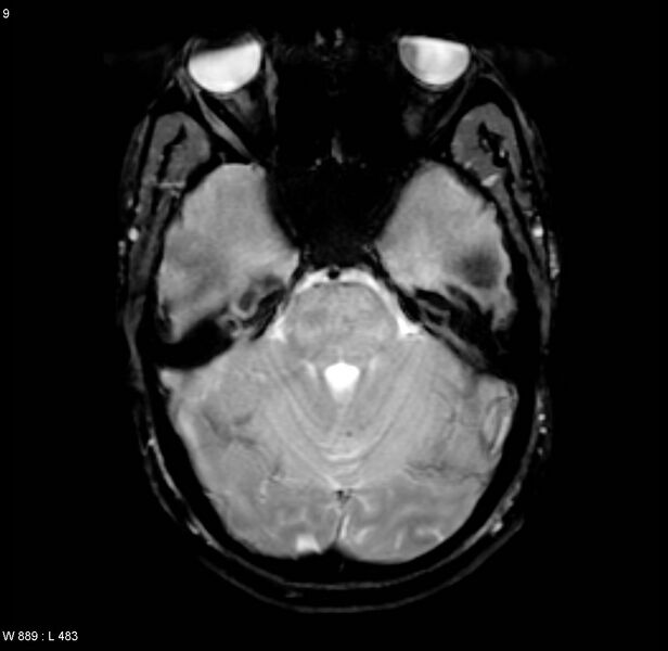 File:Chronic hypertensive encephalopathy (Radiopaedia 4564-6686 Axial Gradient Echo 4).jpg