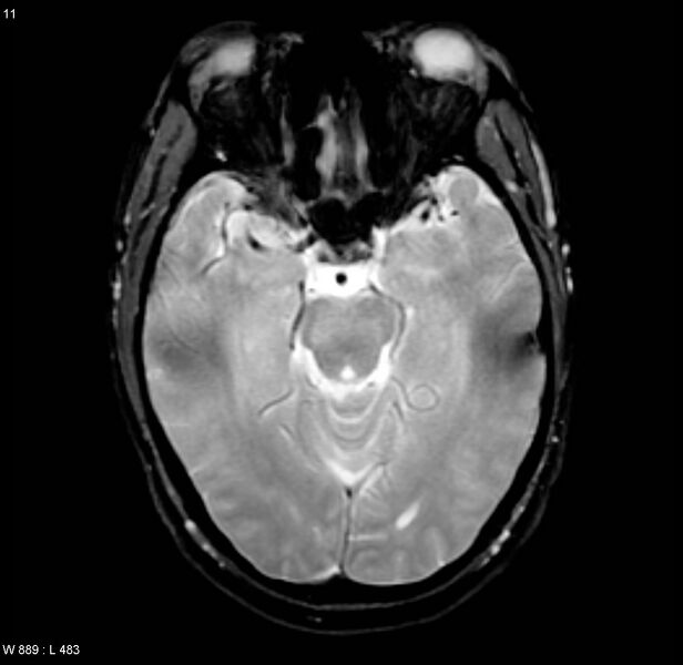 File:Chronic hypertensive encephalopathy (Radiopaedia 4564-6686 Axial Gradient Echo 6).jpg