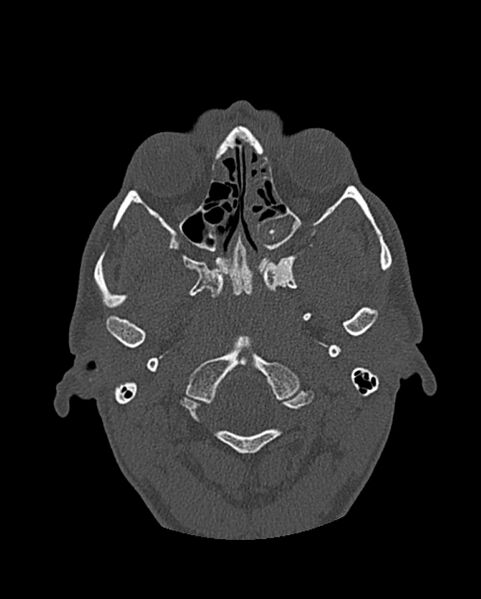 File:Chronic maxillary sinusitis caused by a foreign body (Radiopaedia 58521-65676 Axial bone window 180).jpg