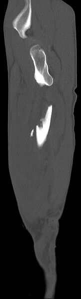 File:Chronic osteomyelitis (with sequestrum) (Radiopaedia 74813-85822 C 91).jpg