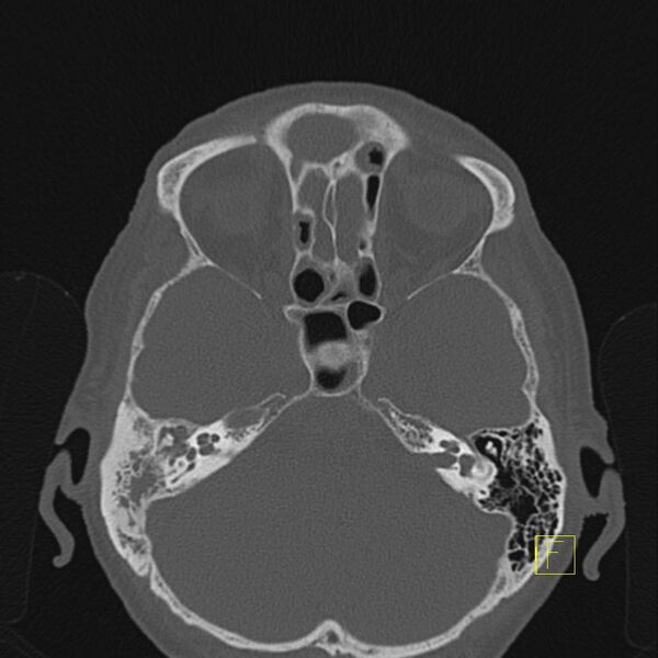 File:Chronic otitis media (Radiopaedia 14994-14912 Axial bone window 8).JPEG