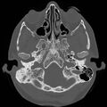 Chronic otomastoiditis (Radiopaedia 27138-27309 Axial bone window 13).jpg