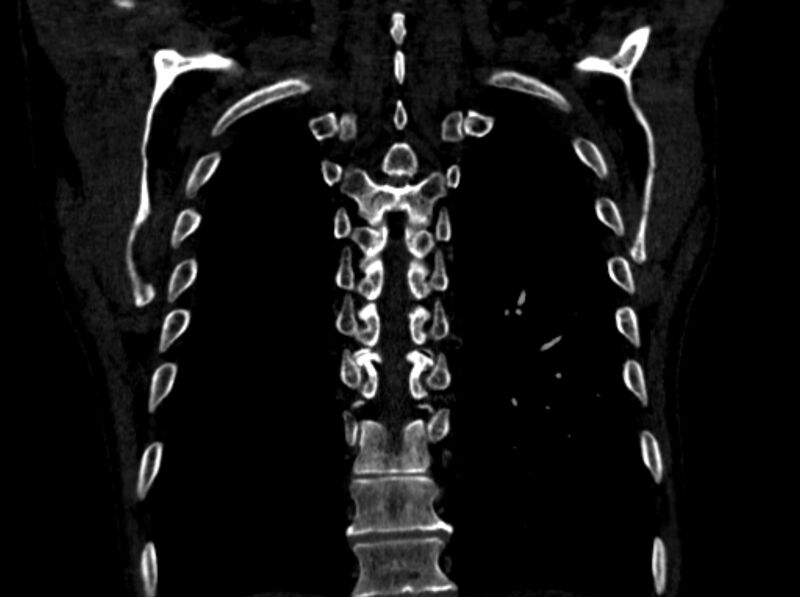 File:Chronic pulmonary embolism (Radiopaedia 91241-108843 A 95).jpg