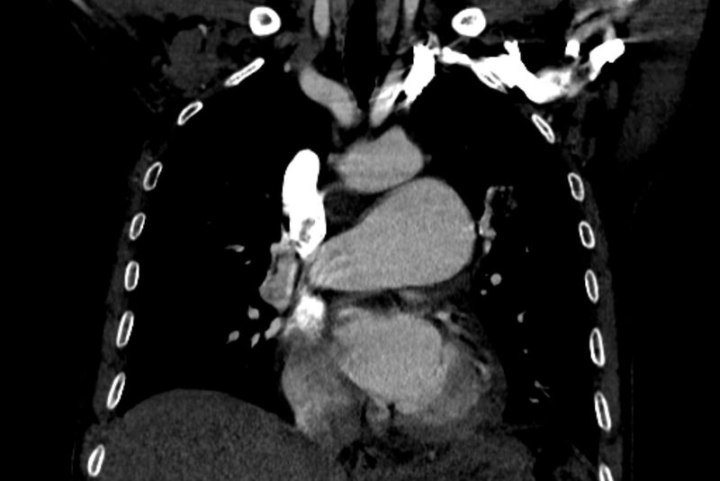 File:Chronic pulmonary embolism with bubbly consolidation (Radiopaedia 91248-108850 B 66).jpg