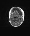 Chronic reactive multifocal osteomyelitis (CRMO) - mandible (Radiopaedia 56405-63069 Axial T1 7).jpg