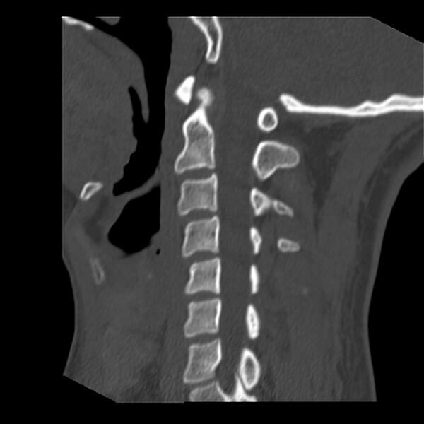 File:Clay-shoveler fracture (Radiopaedia 22568-22590 Sagittal bone window 17).jpg