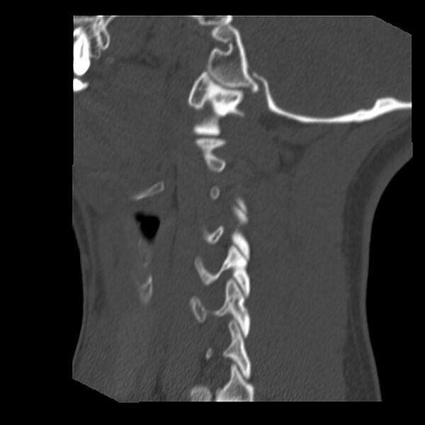 File:Clay-shoveler fracture (Radiopaedia 22568-22590 Sagittal bone window 38).jpg