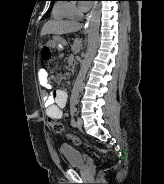 File:Closed-loop small bowel obstruction-internal hernia (Radiopaedia 78439-91096 C 72).jpg