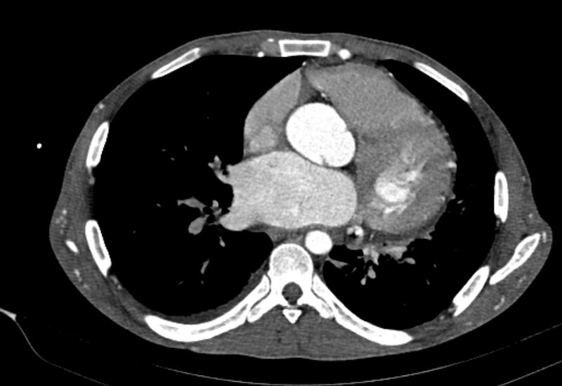 File:Coarctation of aorta with aortic valve stenosis (Radiopaedia 70463-80574 A 117).jpg