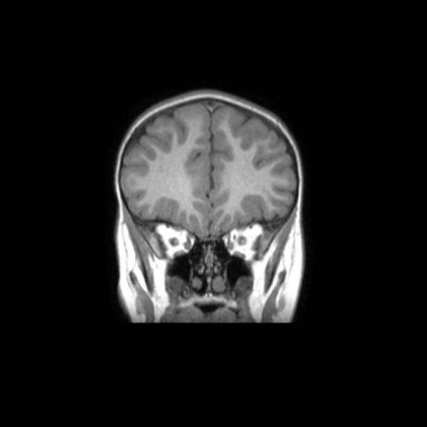 File:Cochlear nerve aplasia - unilateral (Radiopaedia 87910-104413 Coronal T1 14).jpg