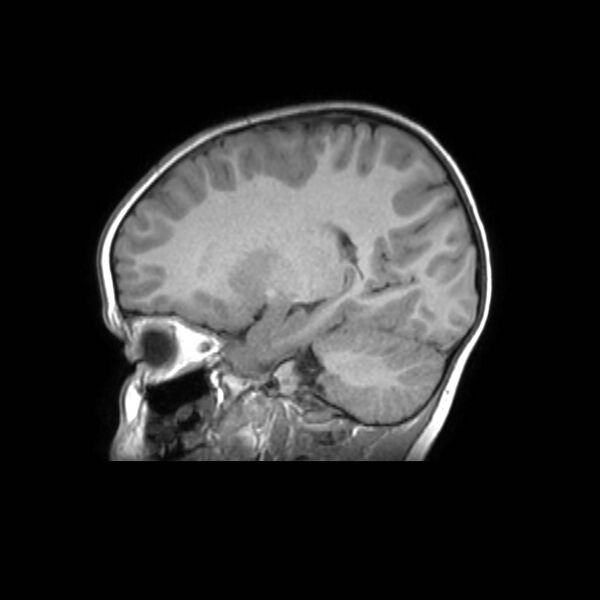 File:Cochlear nerve aplasia - unilateral (Radiopaedia 87910-104413 Sagittal T1 31).jpg