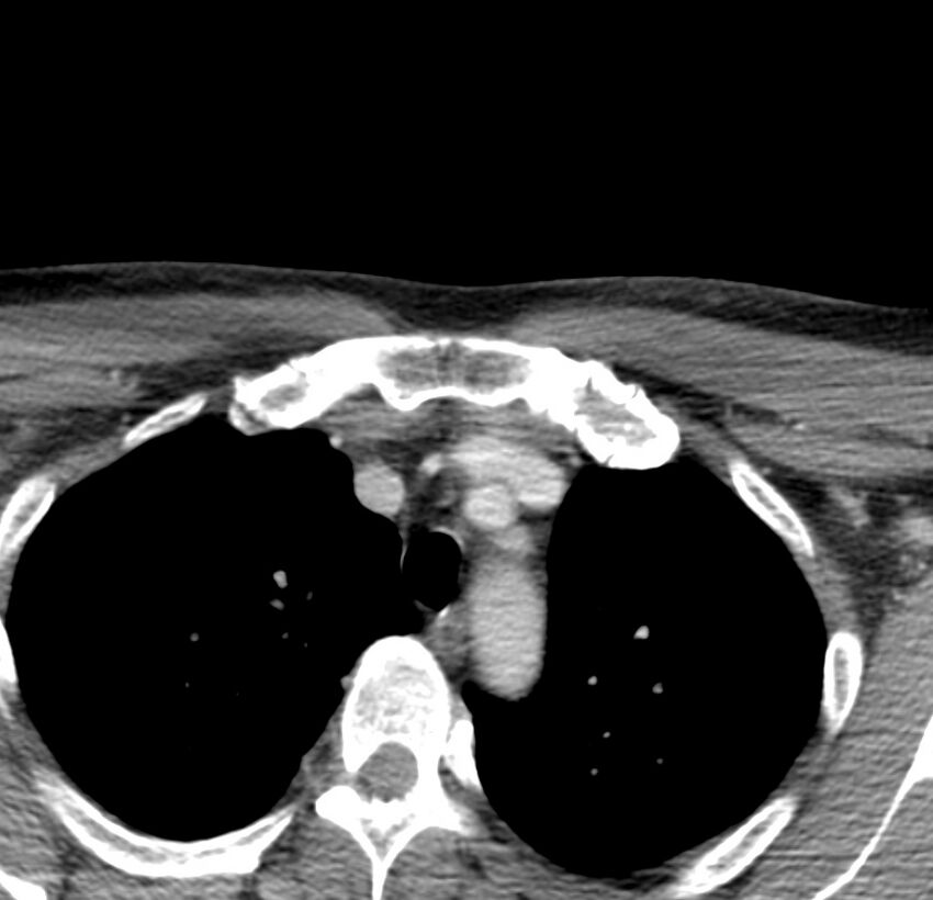 Colloid cyst of thyroid (Radiopaedia 22897-22923 Axial C+ delayed 84).jpg