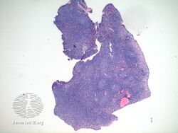 pathology-Eccrine spiradenoma