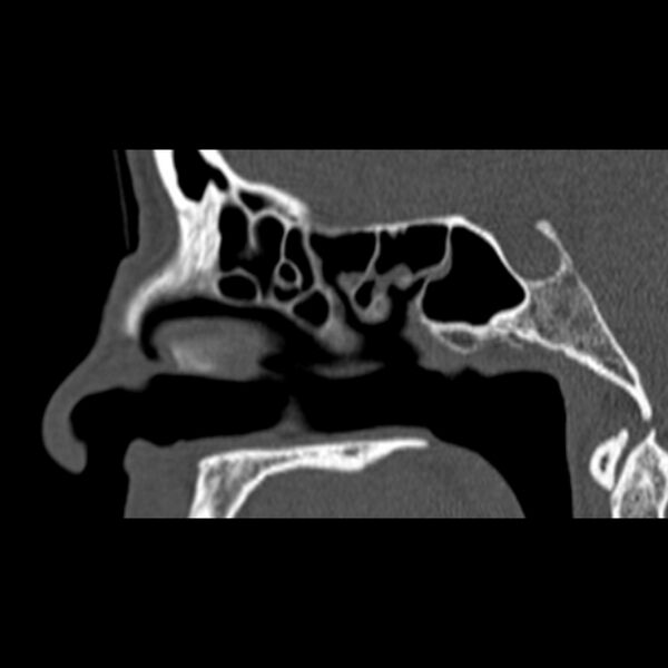 File:Nasal septal perforation (Radiopaedia 25030-25289 Sagittal bone window 34).jpg