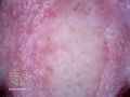 Nasal tip lesion with whitish background, some preservation of follicular plugging and sebaceous hyperplasia (DermNet NZ morphoeic-bcc3).jpg