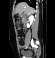 Necrotizing pancreatitis (Radiopaedia 23001-23031 C 25).jpg