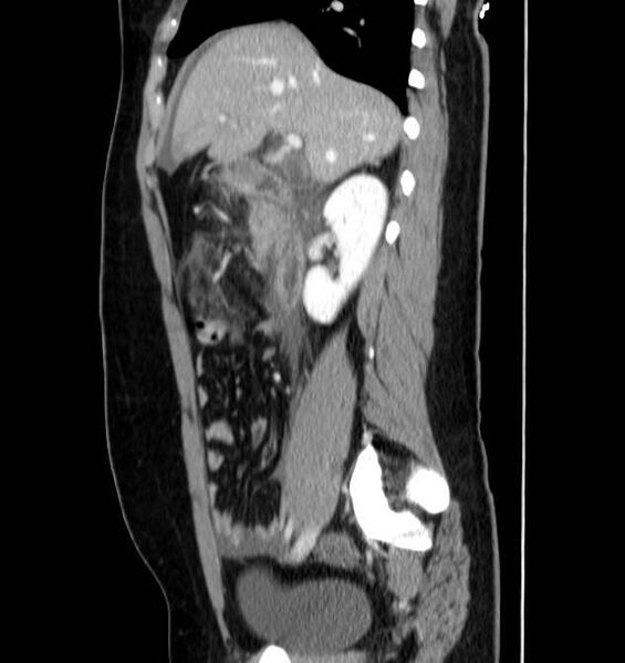 File:Necrotizing pancreatitis (Radiopaedia 23001-23031 C 25).jpg