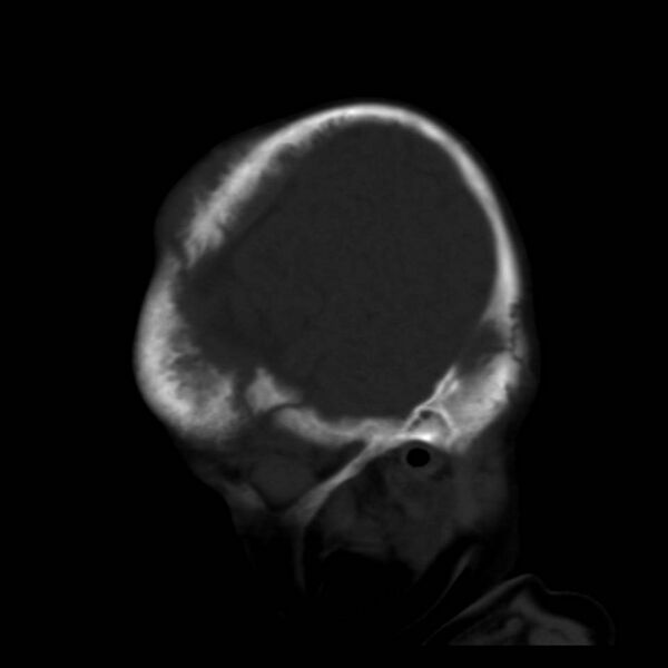 File:Neuroblastoma with skull metastases (Radiopaedia 30326-30958 Sagittal bone window 6).jpg