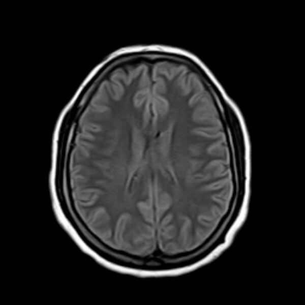 File:Neurofibromatosis type 2 (Radiopaedia 67470-76871 Axial FLAIR 15).jpg
