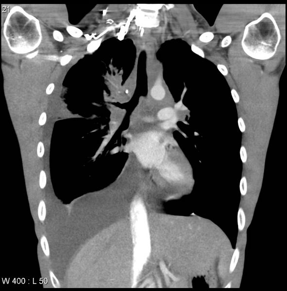 File:Non-Hodgkin lymphoma involving lung (Radiopaedia 29094-29470 C 15).jpg