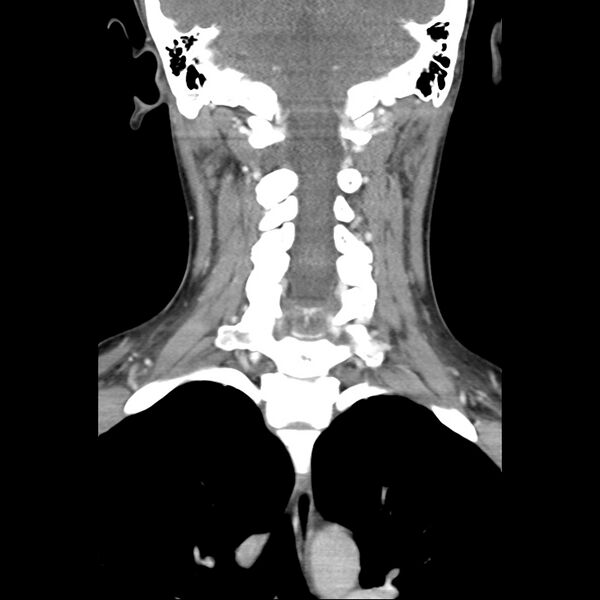 File:Normal CT of the neck (Radiopaedia 14575-14500 Coronal C+ 36).jpg