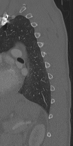 File:Normal CT thoracic spine (Radiopaedia 40181-42688 Sagittal bone window 11).png