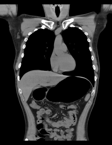 File:Normal CT virtual gastroscopy (Radiopaedia 29960-30501 E 14).jpg