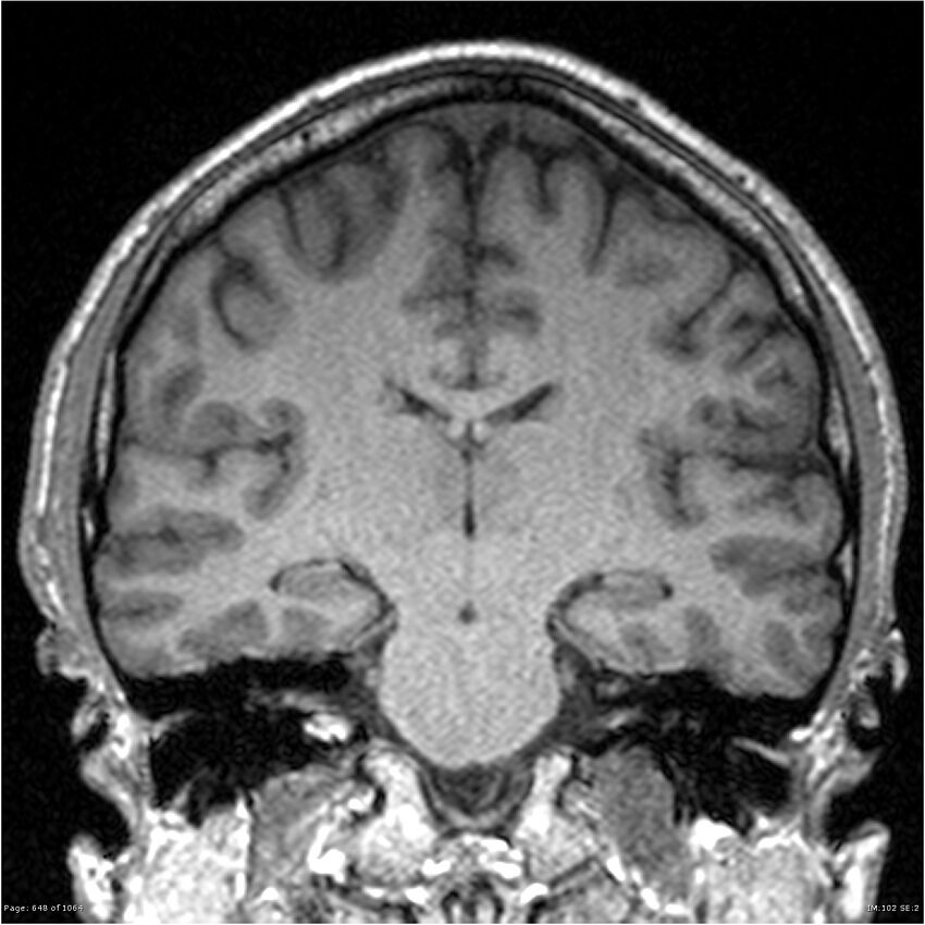Normal brain MRI (non-focal epilepsy protocol) (Radiopaedia 38571-40700 Coronal T1 50).jpg