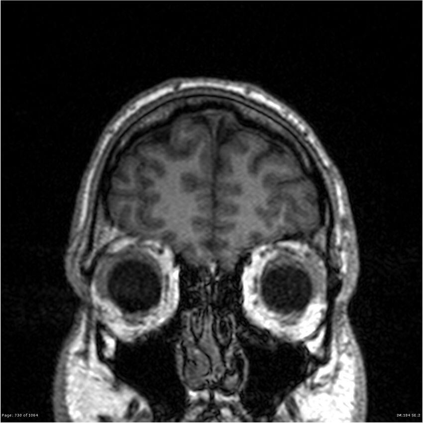 Normal brain MRI (non-focal epilepsy protocol) (Radiopaedia 38571-40700 Coronal T1 91).jpg