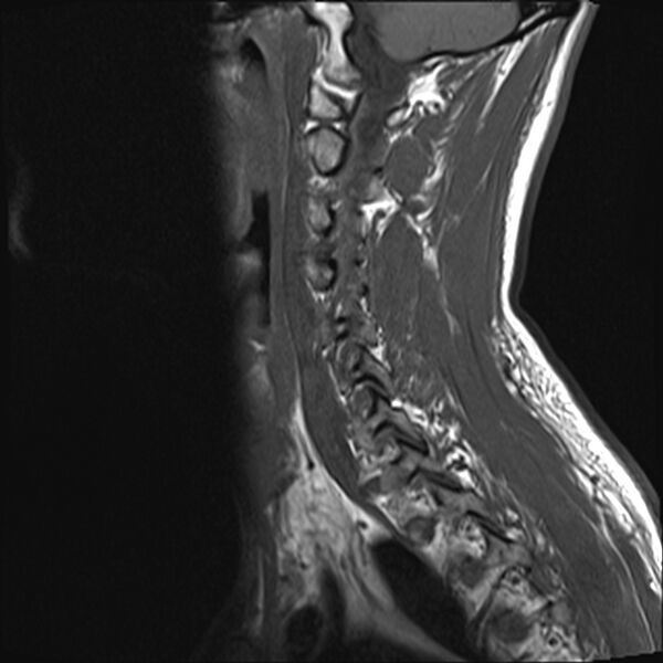 File:Normal cervical spine MRI (Radiopaedia 38418-40496 Sagittal T1 4).jpg