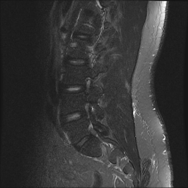 File:Normal lumbar spine MRI (Radiopaedia 43051-46311 Sagittal STIR 15).jpg