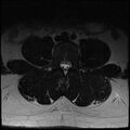 Normal lumbar spine MRI (Radiopaedia 47857-52609 Axial T2 11).jpg