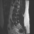 Normal lumbar spine MRI (Radiopaedia 47857-52609 Sagittal T2 16).jpg